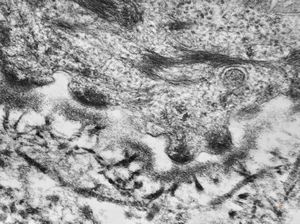 F,23y. | normal oral mucosal epithelium - hemidesmosomes and anchoring fibrils